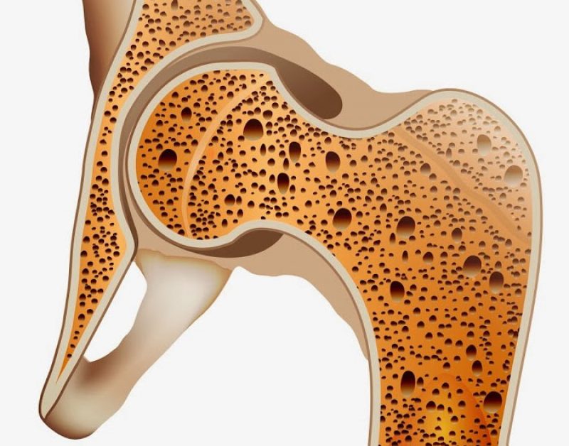osteoporosis.jpg